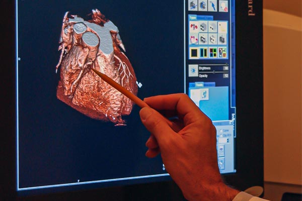 سی تی اسکن قلب چیست و چگونه انجام می شود؟