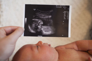 سونوگرافی از جنین در دوران بارداری