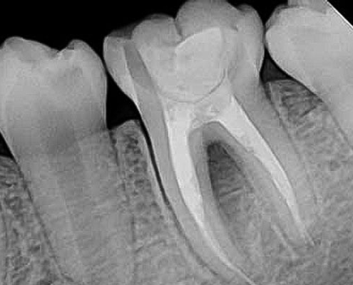 رادیوگرافی پری اپیکال یا تک دندان چیست؟