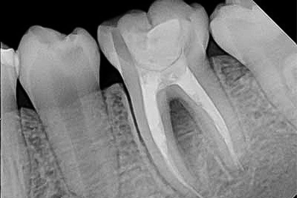 رادیوگرافی پری اپیکال یا تک دندان چیست؟