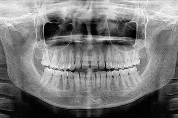 آمادگی برای رادیولوژی دندان
