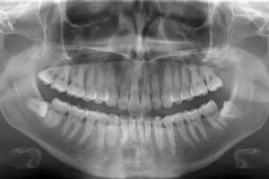 عکس opg دندان در کرج