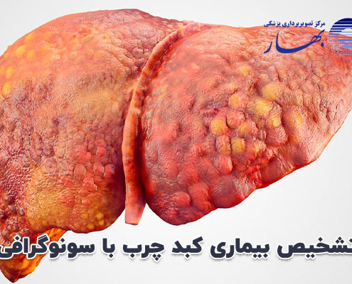 تشخیص بیماری کبد چرب با سونوگرافی