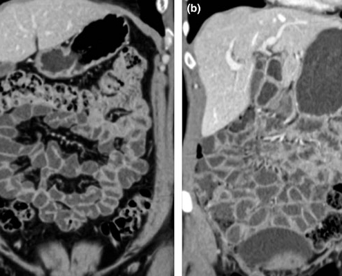 سی تی انتروگرافی (CT Enterography) چیست؟