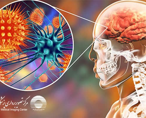 بیماری آنسفالیت مغزی چیست
