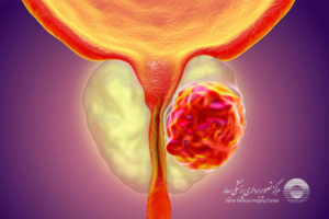 تشخیص سرطان پروستات با سونوگرافی