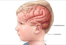 تومور مغزی کودکان