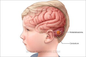 تومور مغزی کودکان