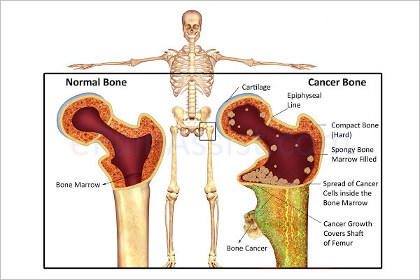 بیماری سرطان استخوان
