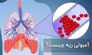 آمبولی ریه چیست چه علائم و درمانی دارد؟