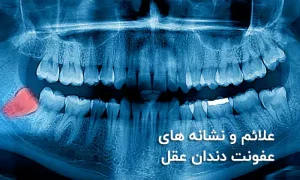 علائم و درمان عفونت دندان عقل