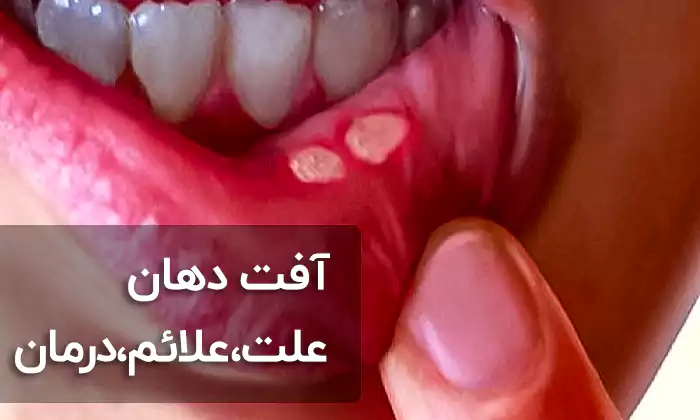 آفت دهان : علت،علائم و درمان