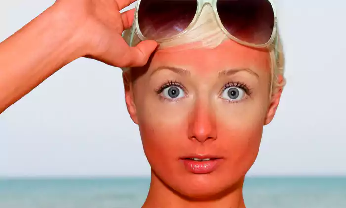 چطور از آفتاب سوختگی پوست پیشگیری کنیم