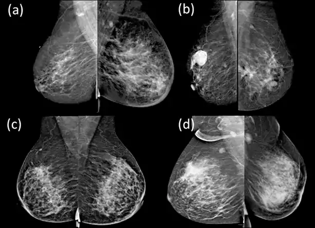 تشخیص سرطان التهابی پستان